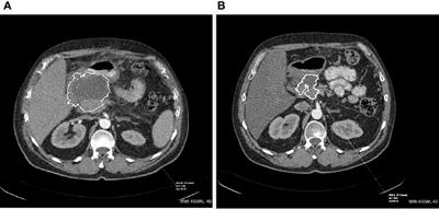 Value of Peptide Receptor Radionuclide Therapy as Neoadjuvant Treatment in the Management of Primary Inoperable Neuroendocrine Tumors